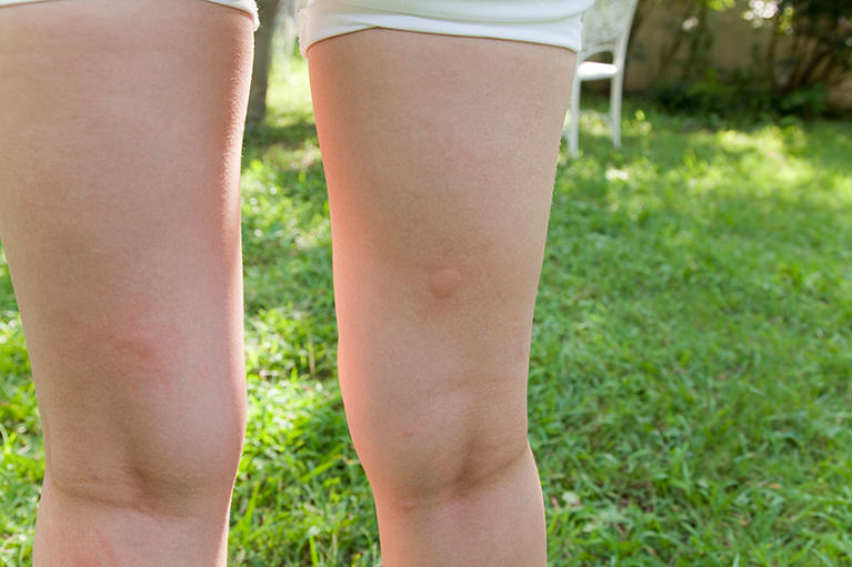 虫刺されについて